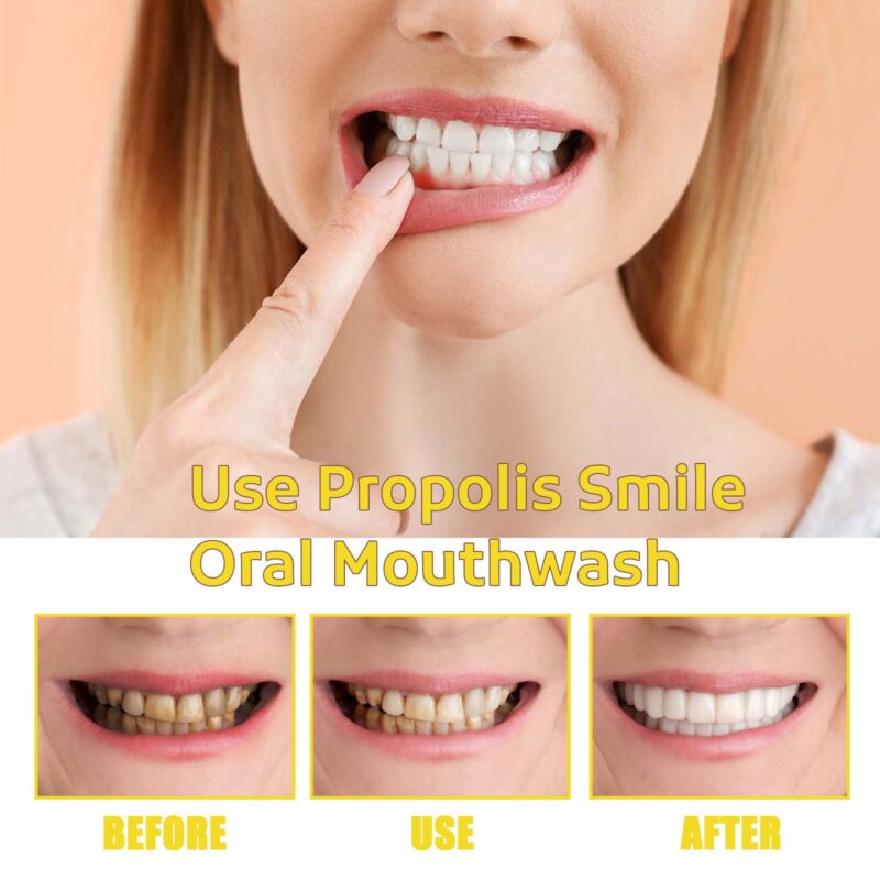 Propolis Oral Cleaning Mousse - Tooth Stain Removal, Fresh Breath & Oral Care, Foaming Mousse - Image 4